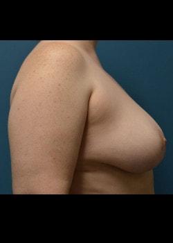 Breast Reduction after at Jessica Belz, MD in San Antonio, TX