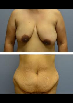 Mommy Makeover before at Jessica Belz, MD in San Antonio, TX