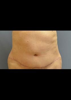 Jessica Belz, MD tummy tuck after — San Antonio, TX