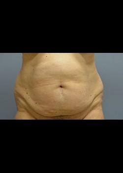 Mini Tummy Tuck before at Jessica Belz, MD in San Antonio, TX