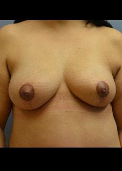 Breast Lift after at Jessica Belz, MD in San Antonio, TX