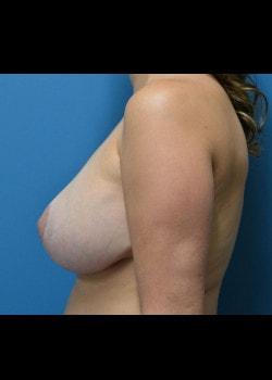 Breast Lift after at Jessica Belz, MD in San Antonio, TX