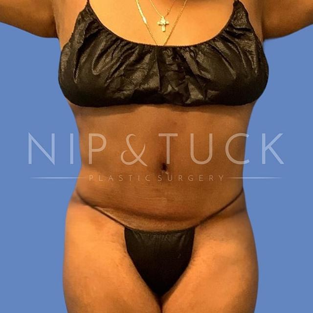 Liposuction after at Dr. Nip and Tuck (Plastic Surgery Inst) in Atlanta, GA