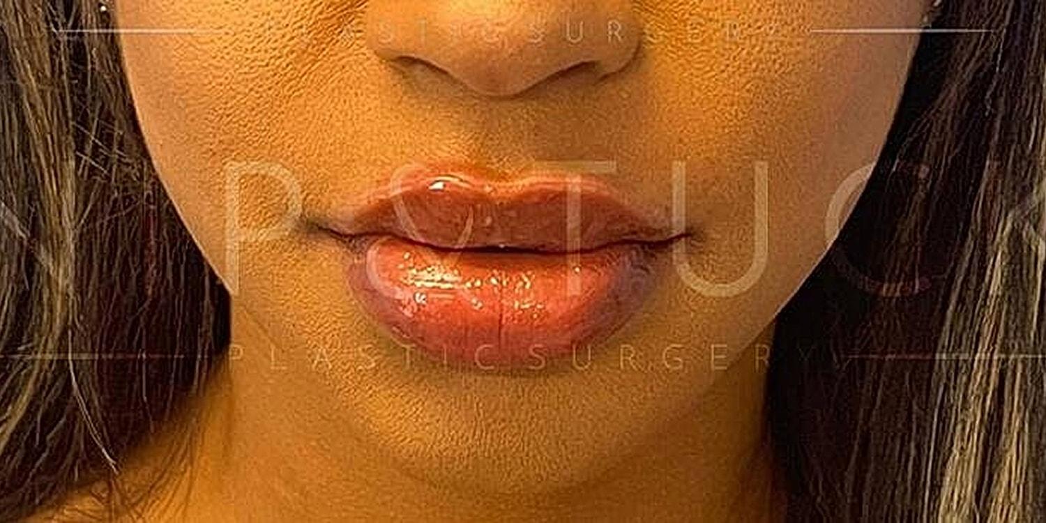 Dr. Nip and Tuck (Plastic Surgery Inst) lip filler result — Atlanta, GA
