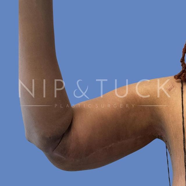Thigh Lift after at Dr. Nip and Tuck (Plastic Surgery Inst) in Atlanta, GA
