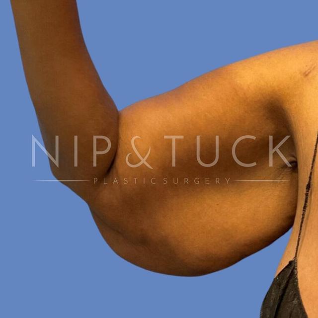 Thigh Lift before at Dr. Nip and Tuck (Plastic Surgery Inst) in Atlanta, GA