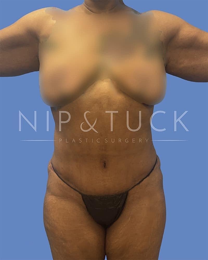 Dr. Nip and Tuck (Plastic Surgery Inst) mommy makeover after — Atlanta, GA