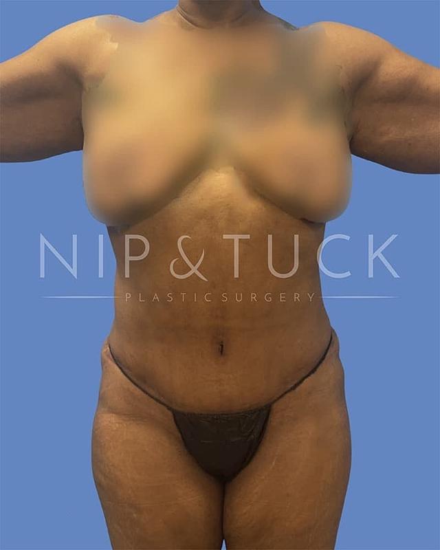 Mommy Makeover after at Dr. Nip and Tuck (Plastic Surgery Inst) in Atlanta, GA