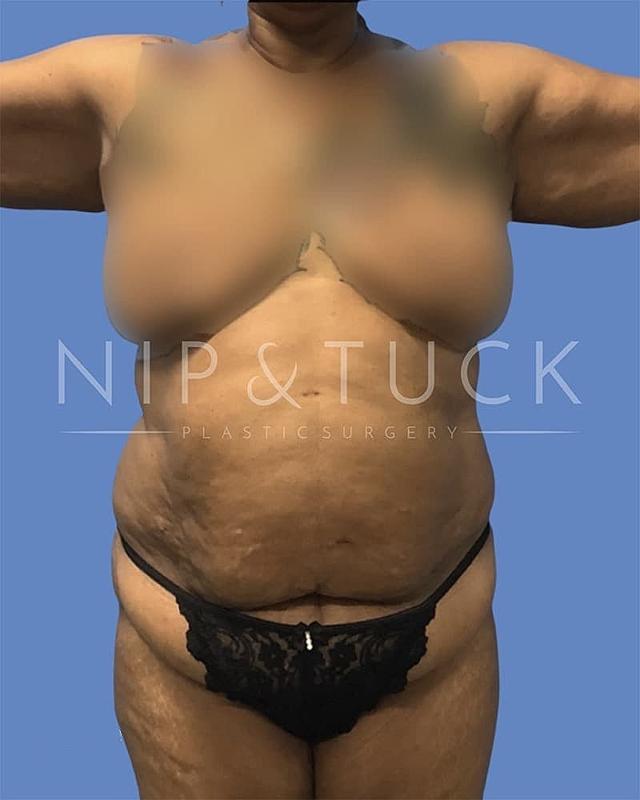 Mommy Makeover before at Dr. Nip and Tuck (Plastic Surgery Inst) in Atlanta, GA