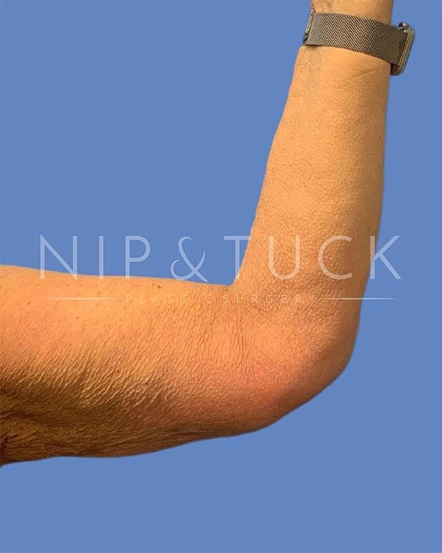 Arm Lift after at Dr. Nip and Tuck (Plastic Surgery Inst) in Atlanta, GA