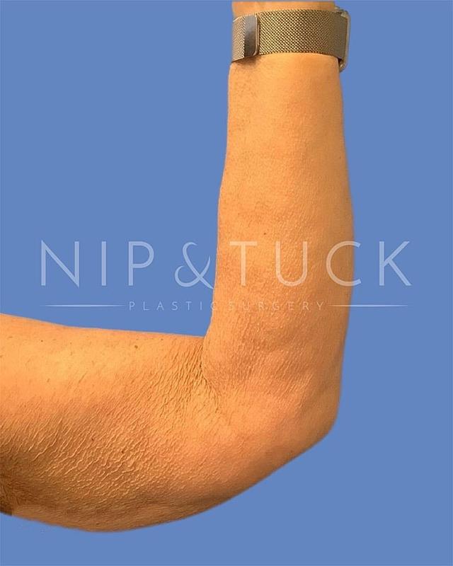 Arm Lift before at Dr. Nip and Tuck (Plastic Surgery Inst) in Atlanta, GA
