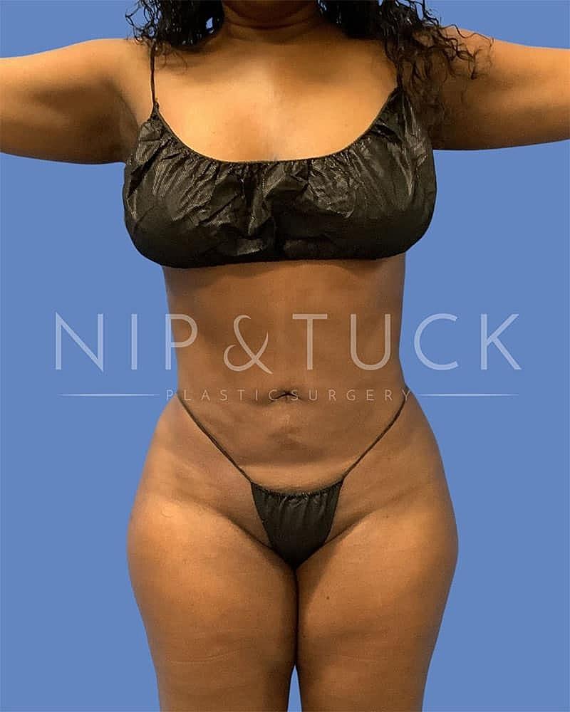 Dr. Nip and Tuck (Plastic Surgery Inst) bbl after — Atlanta, GA
