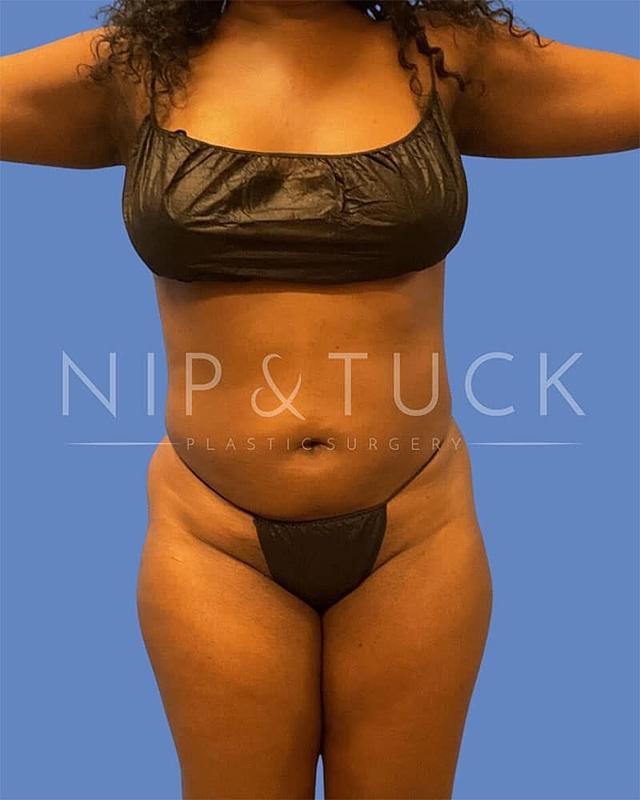Brazilian Butt Lift before at Dr. Nip and Tuck (Plastic Surgery Inst) in Atlanta, GA