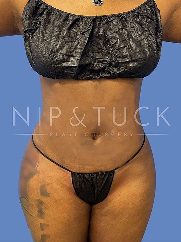 Dr. Nip and Tuck (Plastic Surgery Inst) bbl after — Atlanta, GA