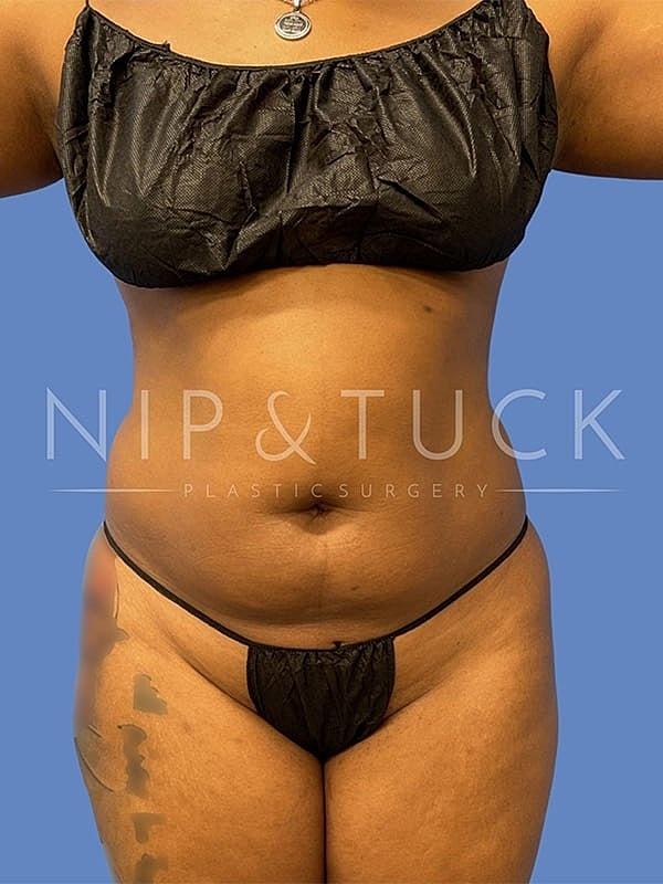 Brazilian Butt Lift before at Dr. Nip and Tuck (Plastic Surgery Inst) in Atlanta, GA
