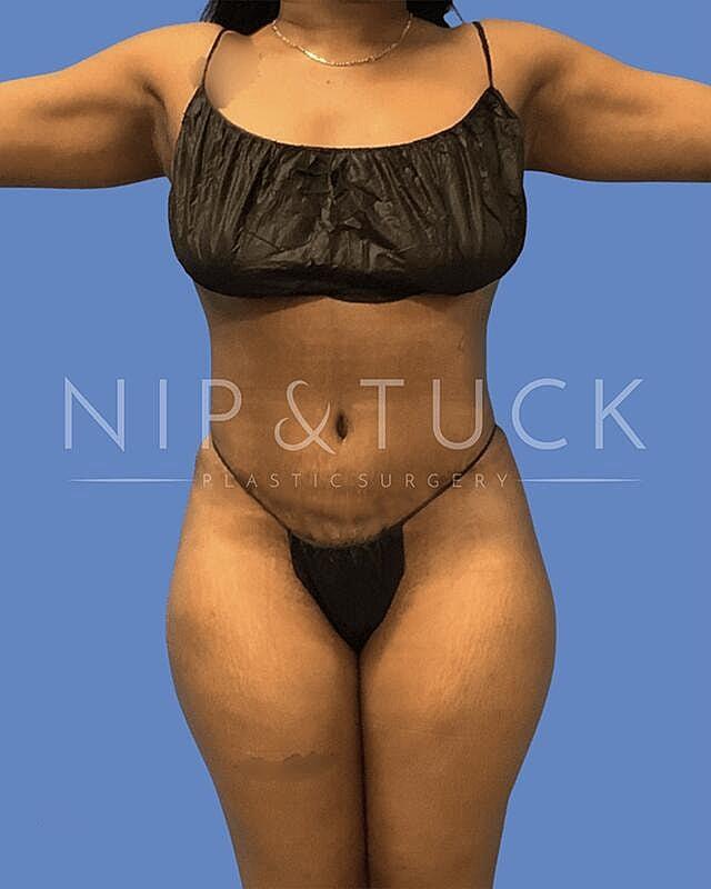 Dr. Nip and Tuck (Plastic Surgery Inst) liposuction after — Atlanta, GA