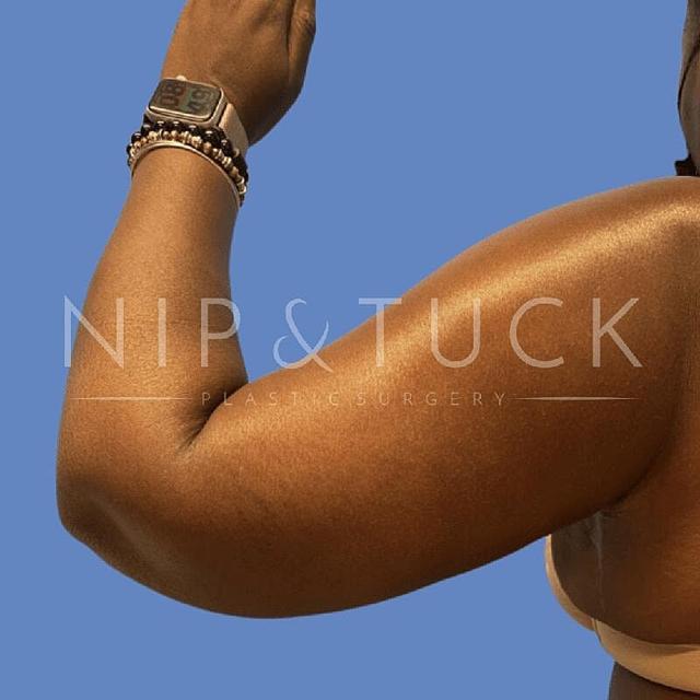 Arm Lift after at Dr. Nip and Tuck (Plastic Surgery Inst) in Atlanta, GA