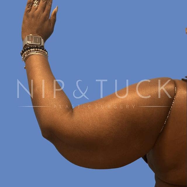 Arm Lift before at Dr. Nip and Tuck (Plastic Surgery Inst) in Atlanta, GA