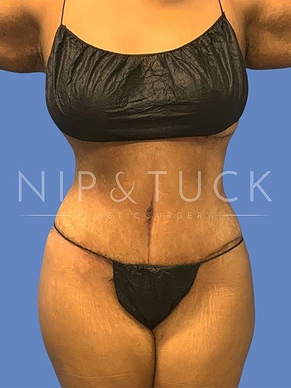 Dr. Nip and Tuck (Plastic Surgery Inst) tummy tuck after — Atlanta, GA
