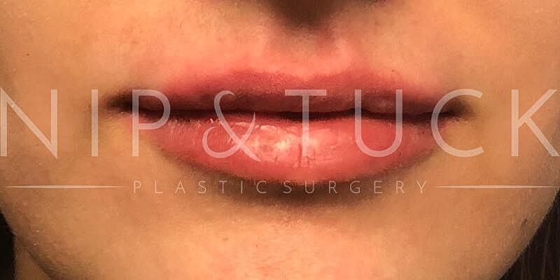Dr. Nip and Tuck (Plastic Surgery Inst) lip filler result — Atlanta, GA