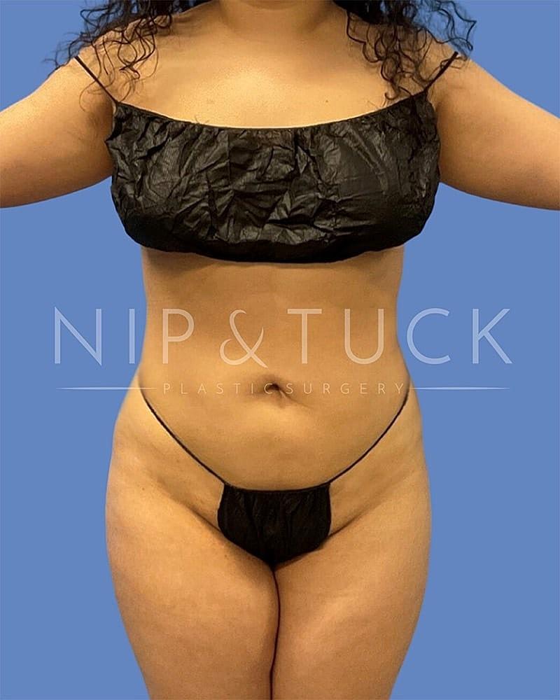 Dr. Nip and Tuck (Plastic Surgery Inst) liposuction after — Atlanta, GA