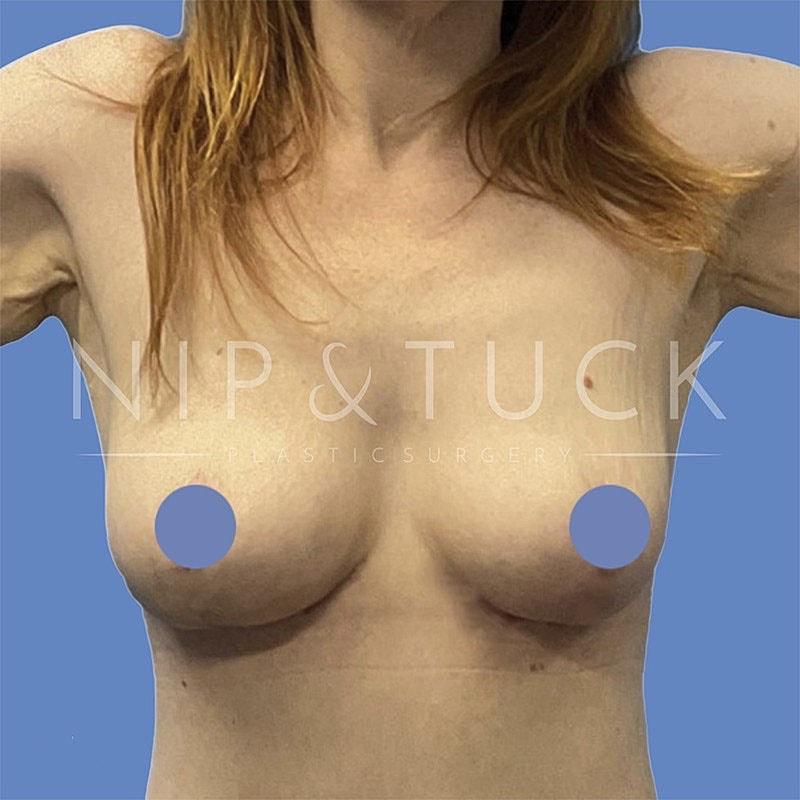 Dr. Nip and Tuck (Plastic Surgery Inst) breast lift after — Atlanta, GA
