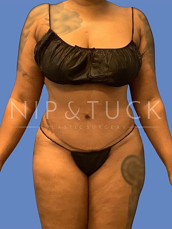 Dr. Nip and Tuck (Plastic Surgery Inst) tummy tuck after — Atlanta, GA