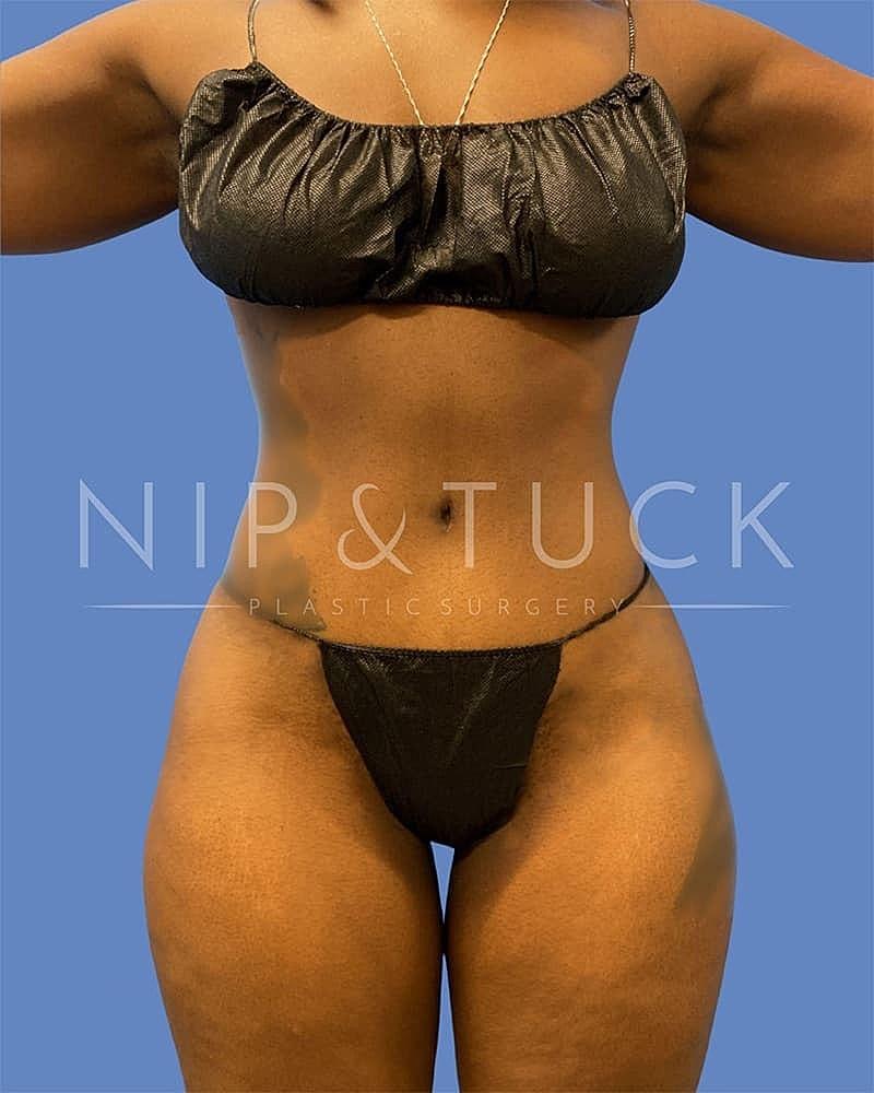 Dr. Nip and Tuck (Plastic Surgery Inst) mommy makeover after — Atlanta, GA