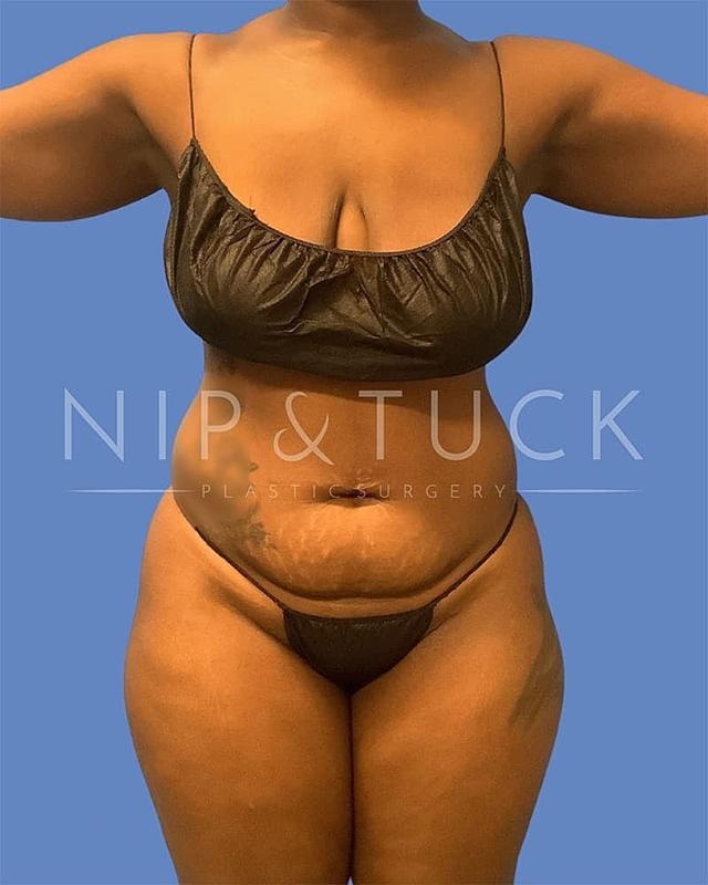 Mommy Makeover before at Dr. Nip and Tuck (Plastic Surgery Inst) in Atlanta, GA