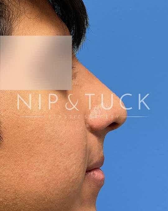 Ethnic Rhinoplasty after at Dr. Nip and Tuck (Plastic Surgery Inst) in Atlanta, GA
