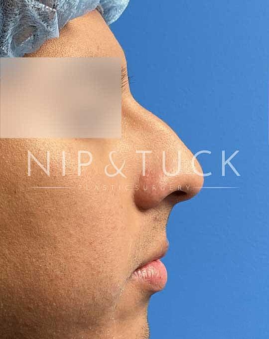 Ethnic Rhinoplasty before at Dr. Nip and Tuck (Plastic Surgery Inst) in Atlanta, GA