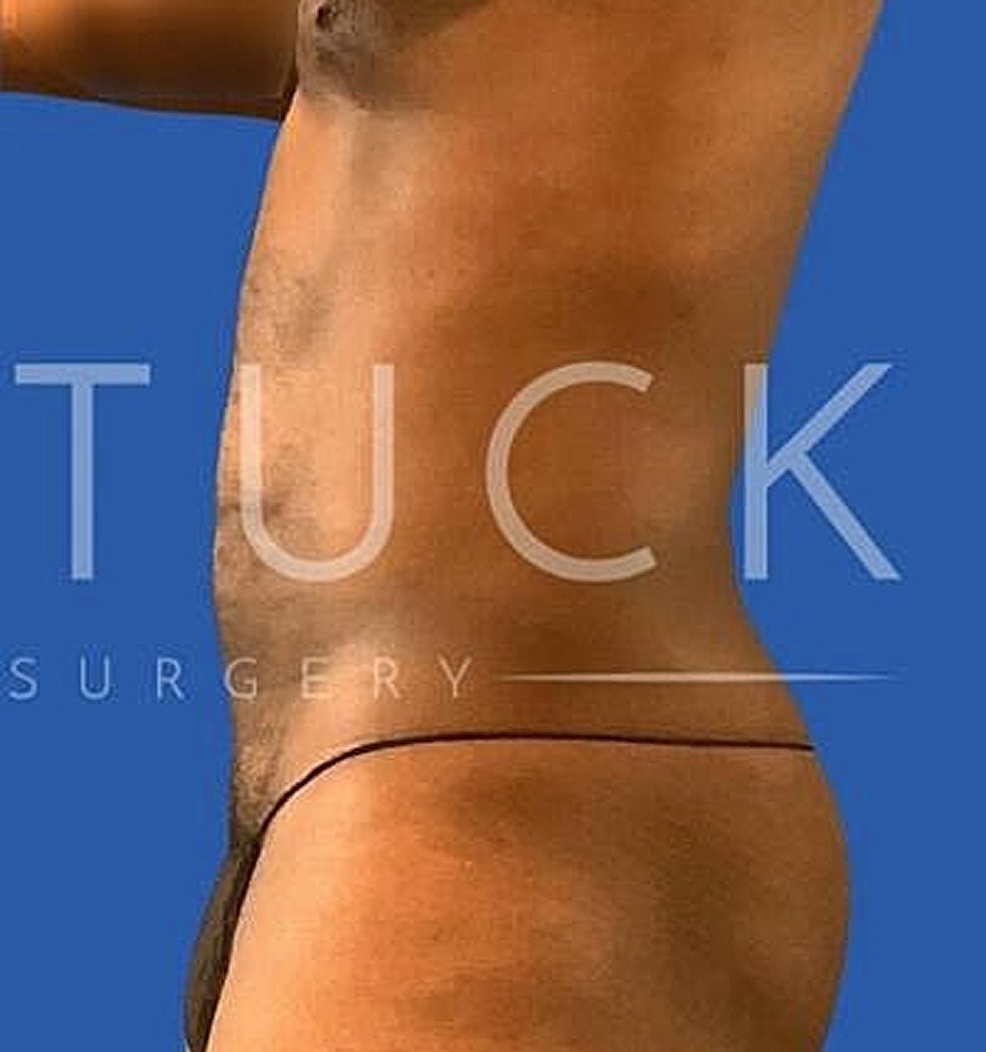 Dr. Nip and Tuck (Plastic Surgery Inst) liposuction after — Atlanta, GA