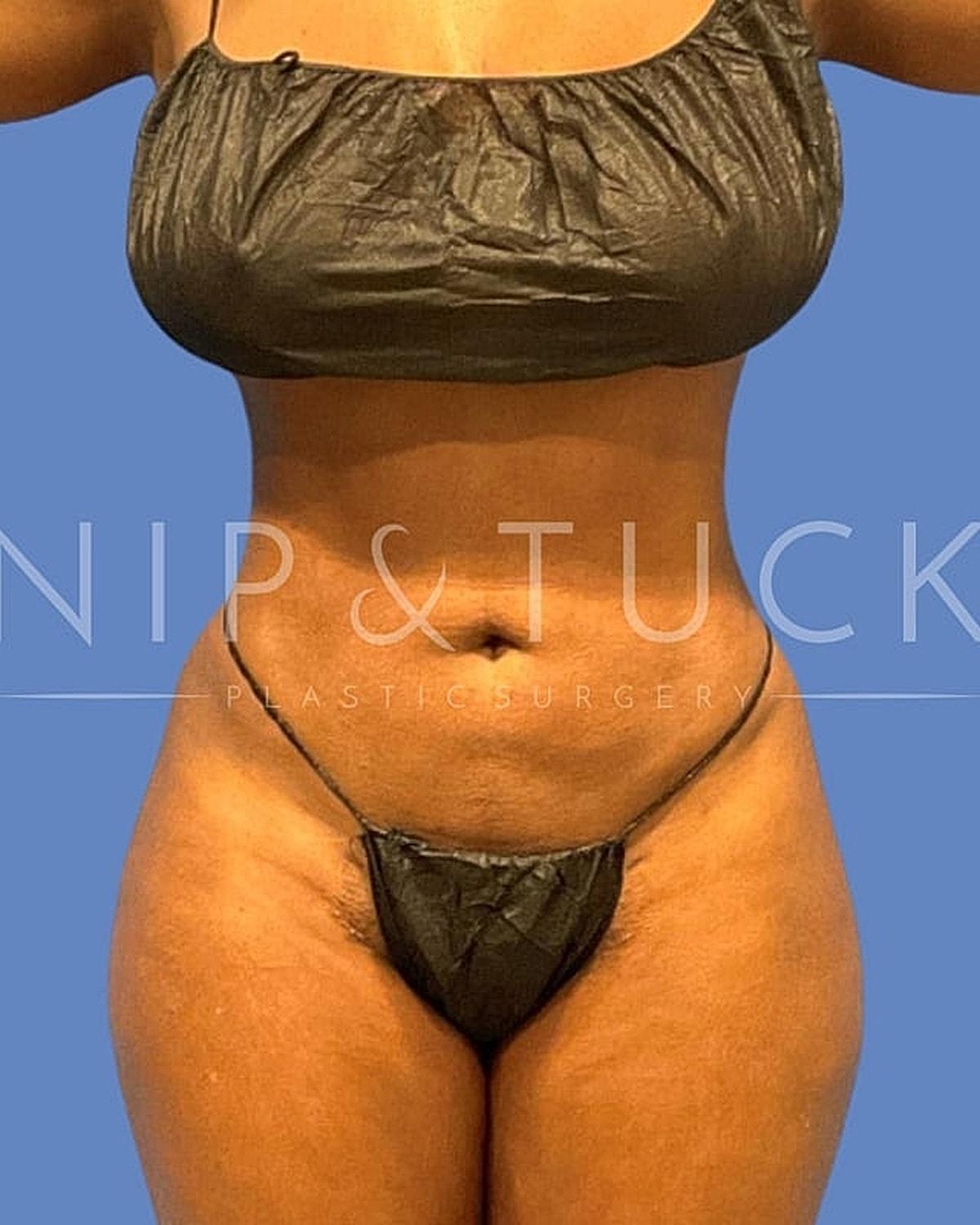 Dr. Nip and Tuck (Plastic Surgery Inst) bbl after — Atlanta, GA