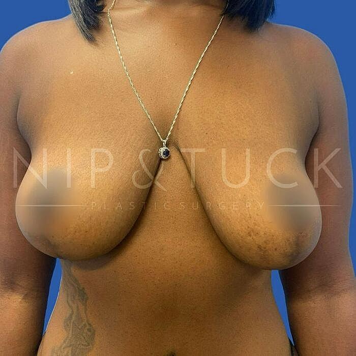 Dr. Nip and Tuck (Plastic Surgery Inst) breast reduction after — Atlanta, GA