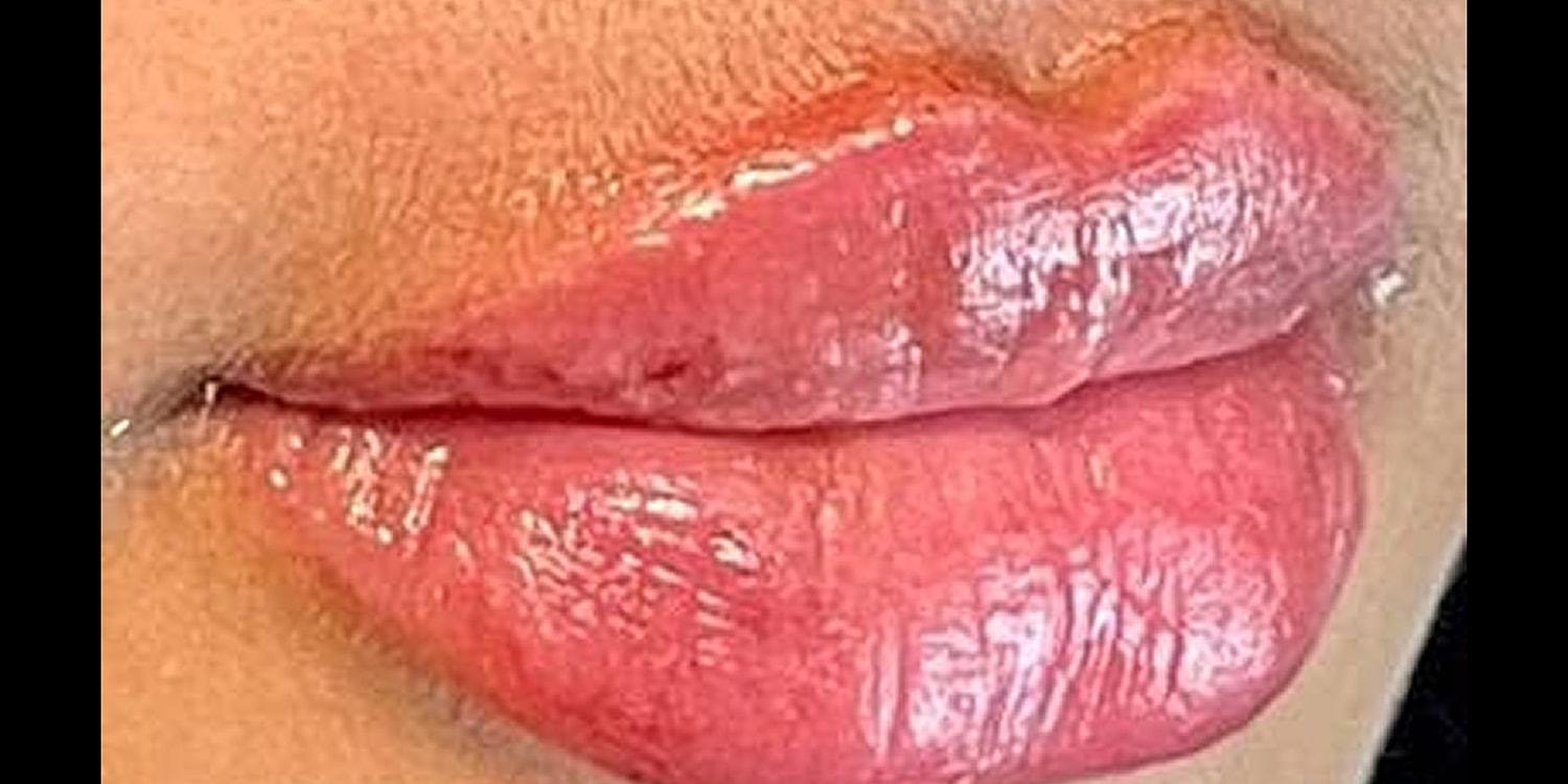 Dr. Nip and Tuck (Plastic Surgery Inst) lip filler result — Atlanta, GA