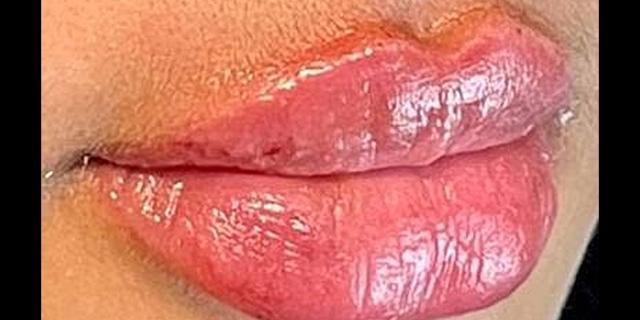 Dermal Fillers result at Dr. Nip and Tuck (Plastic Surgery Inst) in Atlanta, GA