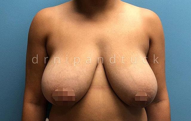 Breast Reduction before at Dr. Nip and Tuck (Plastic Surgery Inst) in Atlanta, GA