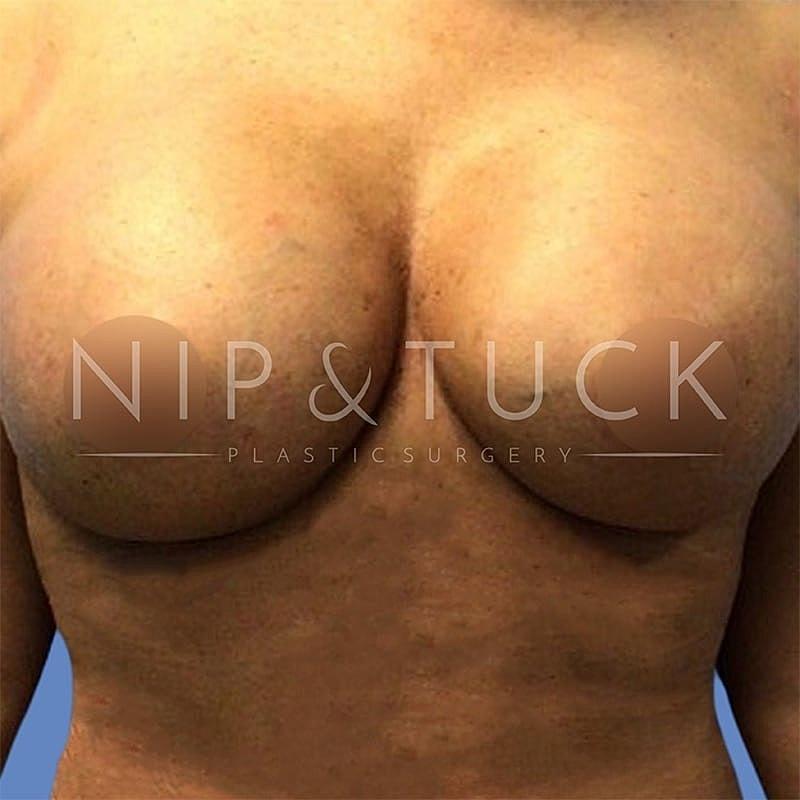 Dr. Nip and Tuck (Plastic Surgery Inst) breast augmentation after — Atlanta, GA