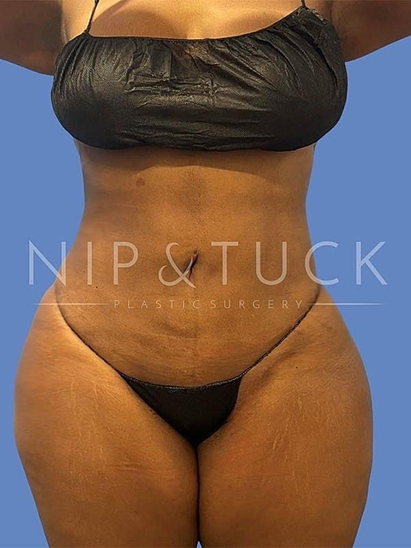 Dr. Nip and Tuck (Plastic Surgery Inst) tummy tuck after — Atlanta, GA