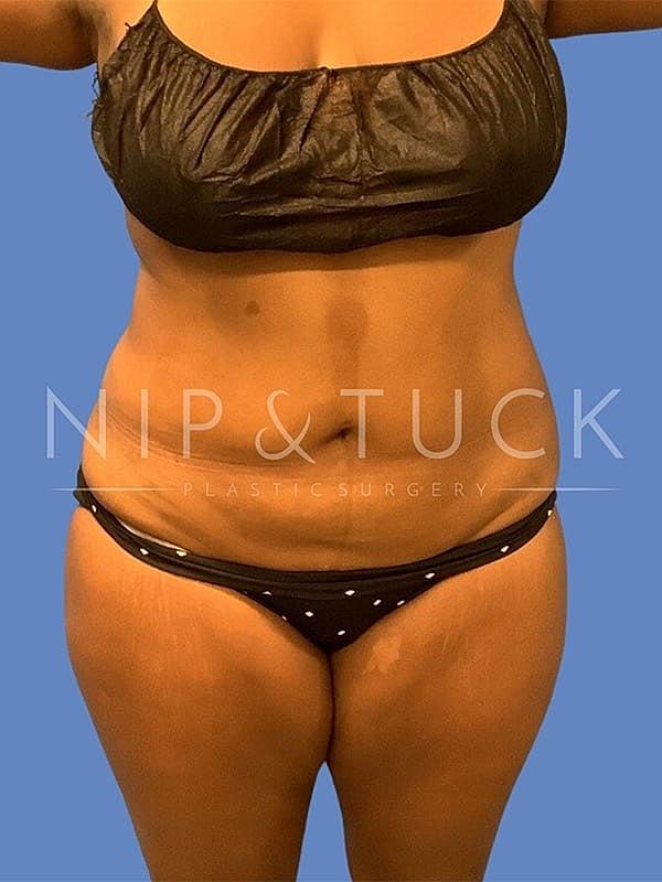 Tummy Tuck before at Dr. Nip and Tuck (Plastic Surgery Inst) in Atlanta, GA