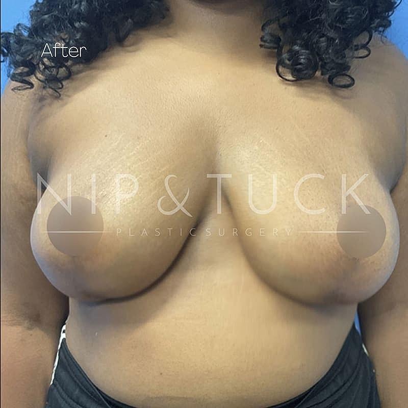 Dr. Nip and Tuck (Plastic Surgery Inst) breast lift after — Atlanta, GA
