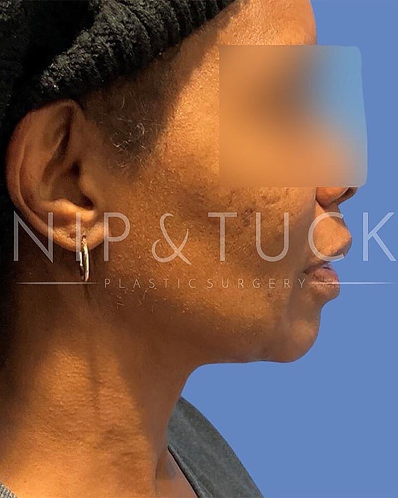 Dr. Nip and Tuck (Plastic Surgery Inst) liposuction after — Atlanta, GA