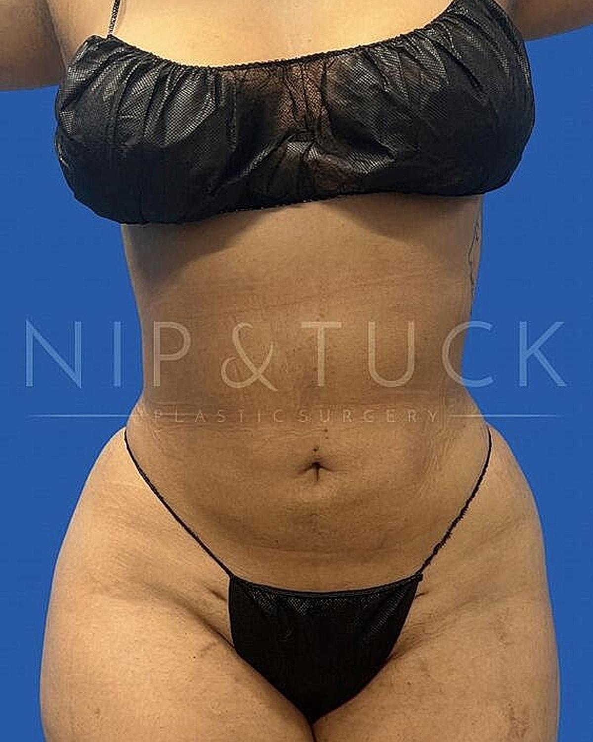 Dr. Nip and Tuck (Plastic Surgery Inst) liposuction after — Atlanta, GA