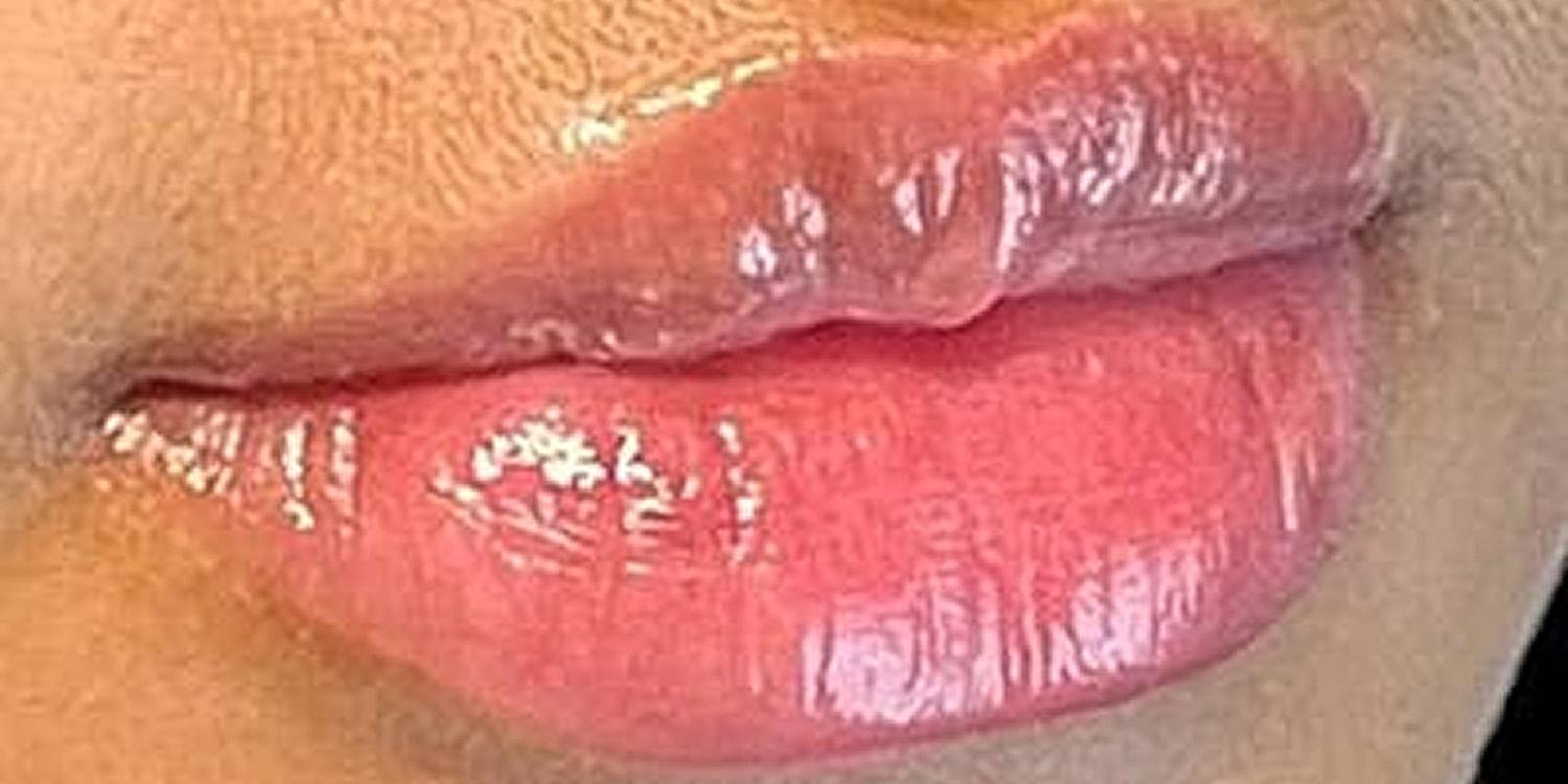 Dr. Nip and Tuck (Plastic Surgery Inst) lip filler result — Atlanta, GA
