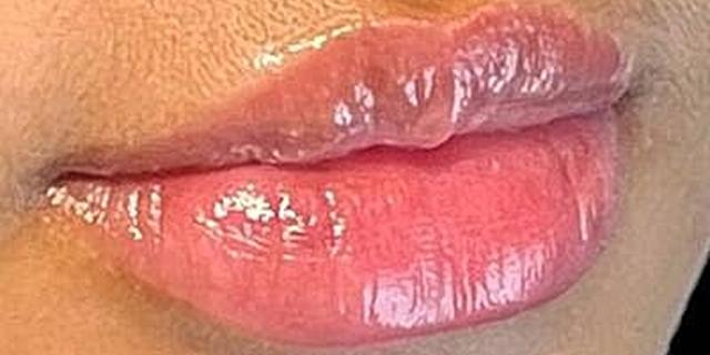 Dermal Fillers result at Dr. Nip and Tuck (Plastic Surgery Inst) in Atlanta, GA