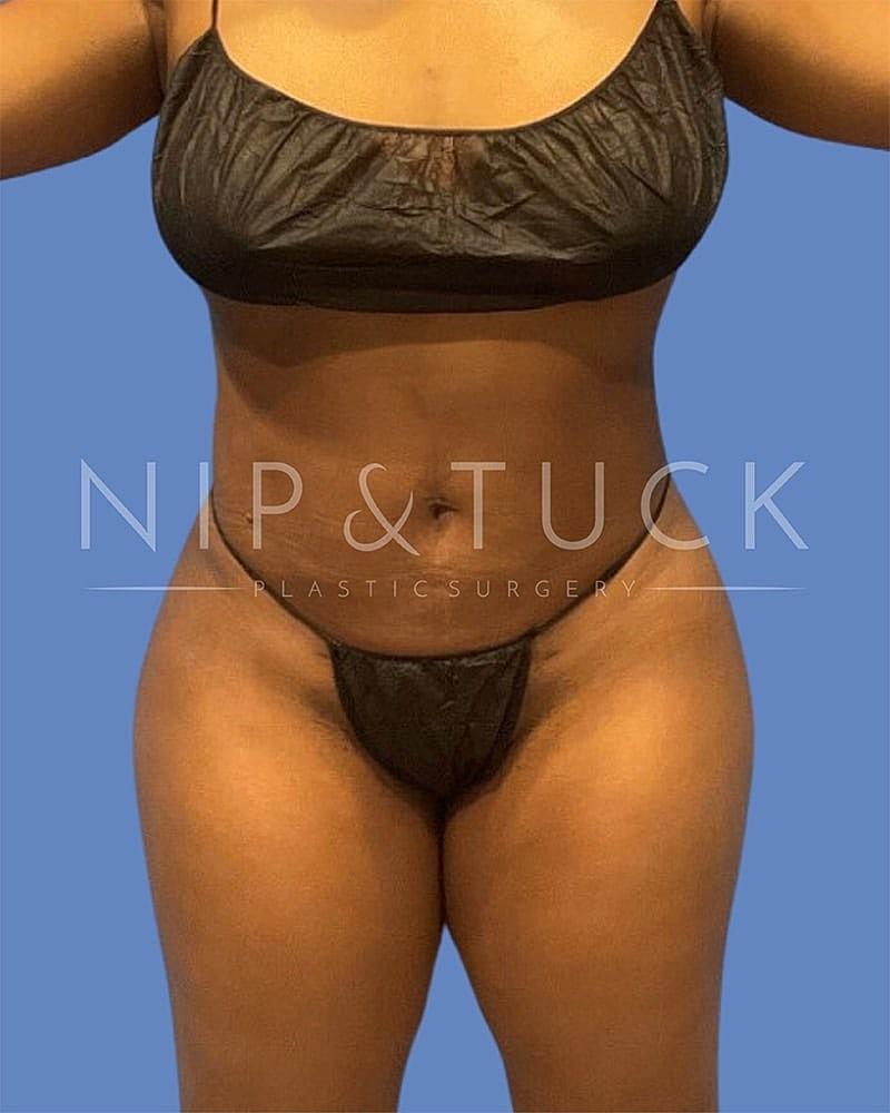 Dr. Nip and Tuck (Plastic Surgery Inst) bbl after — Atlanta, GA