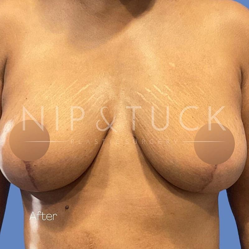 Dr. Nip and Tuck (Plastic Surgery Inst) breast lift after — Atlanta, GA