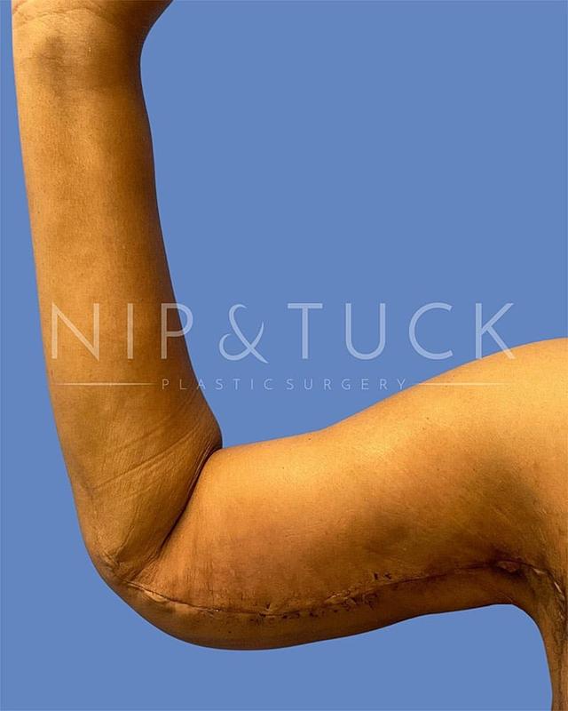 Arm Lift after at Dr. Nip and Tuck (Plastic Surgery Inst) in Atlanta, GA