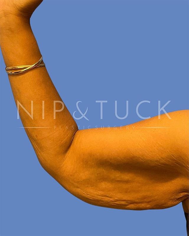 Arm Lift before at Dr. Nip and Tuck (Plastic Surgery Inst) in Atlanta, GA