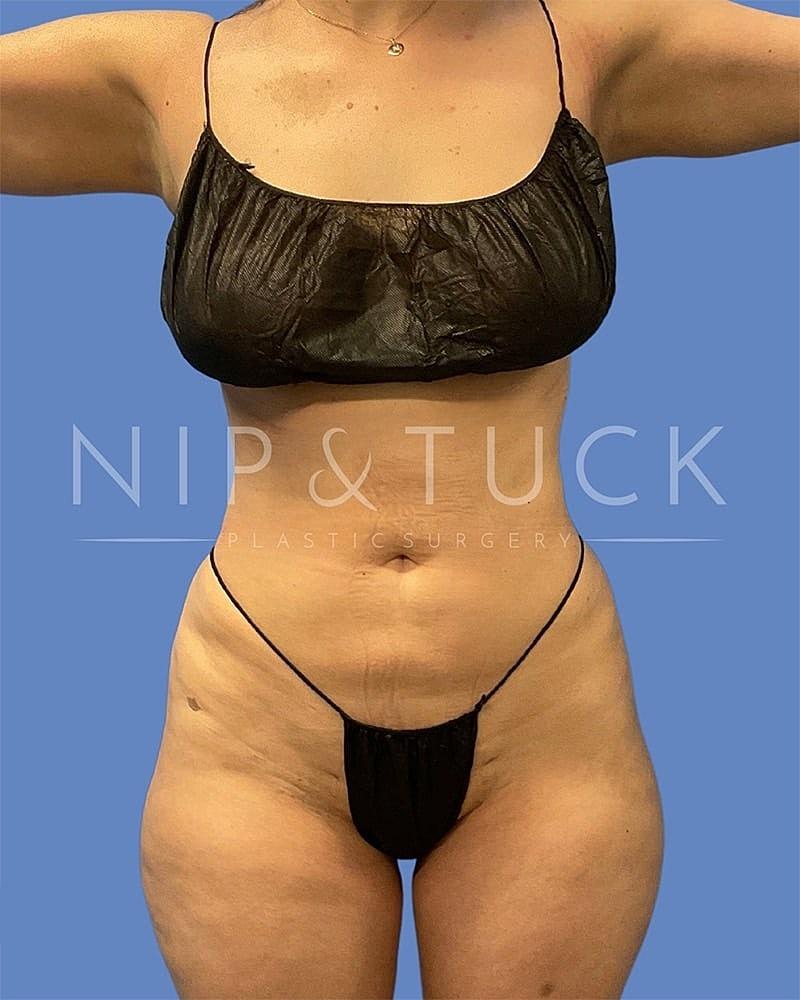 Dr. Nip and Tuck (Plastic Surgery Inst) mommy makeover after — Atlanta, GA